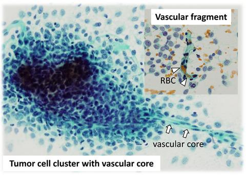 Cytological Features Of Bcor Ccnb3 Sarcoma Comparison With Ewing Sarcoma And Synovial Sarcoma Cytopathology X Mol