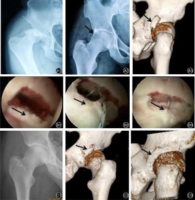 外伤性髋关节脱位后髋臼缘骨折的关节镜治疗：病例系列研究,Orthopaedic 