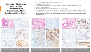 Secondary malignancy after urologic reconstruction procedures: a