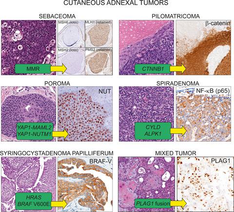 皮肤附件肿瘤的分子病理学,Histopathology - X-MOL