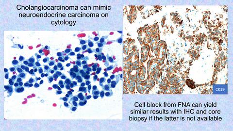 胆管癌：细胞学的诊断困境,Cytopathology - X-MOL