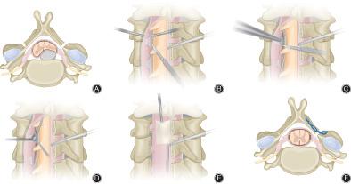 颈椎间盘切除联合椎板成形术治疗多节段颈椎管狭窄伴颈椎间盘突出症 