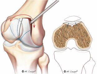 髌股关节不稳滑车成形术后并发症发生率低，患者满意度高,Knee Surgery 