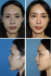 鼻形成術 Aesthetic Rhinoplasty 美容外科手術手技 裁断済-