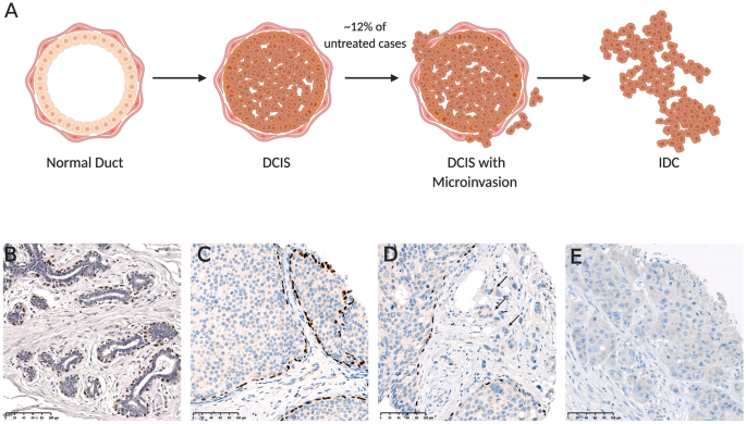 Ductal Carcinoma in Situ: Molecular Changes Accompanying Disease ...