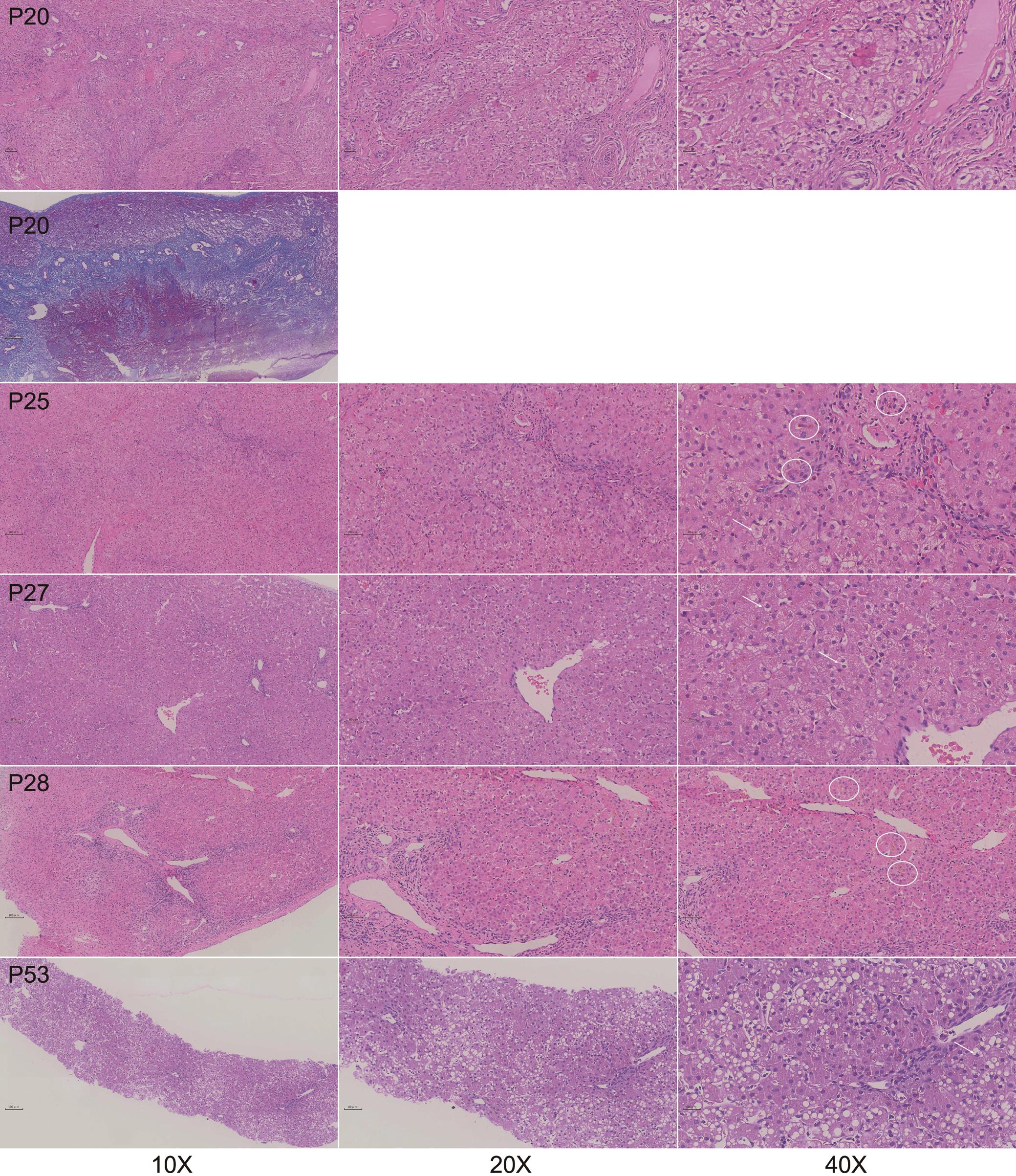 新生儿dubin Johnson 综合征及其与胆道闭锁的鉴别 Journal Of Clinical And Translational Hepatology X Mol