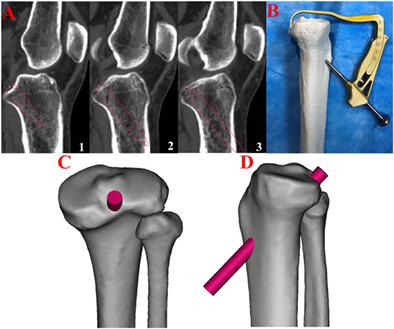 The Permissive Safe Angle of the Tibial Tunnel in Transtibial 