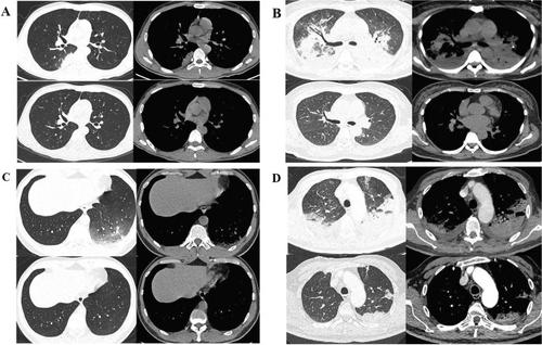 Clinical Characteristics Of Chlamydia Psittaci Pneumonia Infection In Central South China 2562