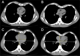 Use of Biomaterials for Pectus Excavatum Surgery,Indian Journal of