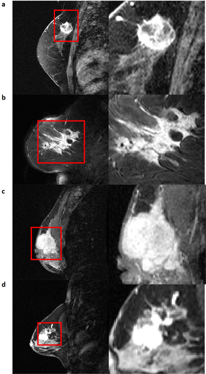 Expert tumor annotations and radiomics for locally advanced breast