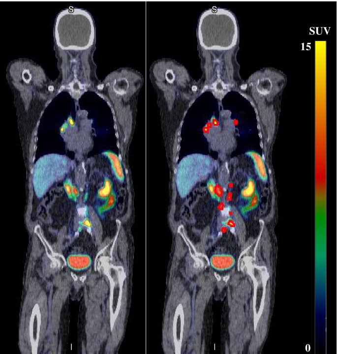 从全身 [68Ga]Ga-PSMA-11 PET/CT 图像中的转移性前列腺病变分割中全自动提取预后生物标志物,European ...