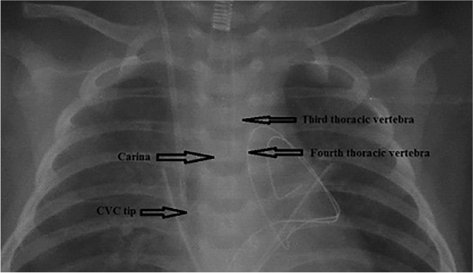Fourth thoracic vertebra as landmark for depth of right internal ...