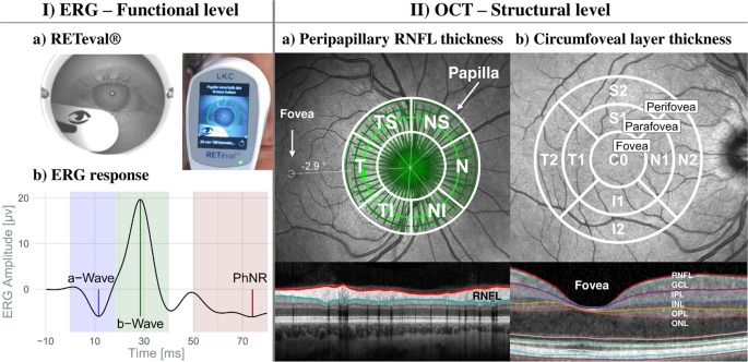 偏执型精神分裂症患者的结构和功能性视网膜改变,Translational 