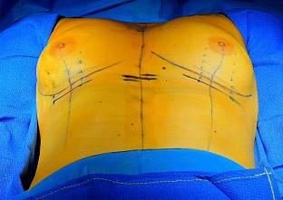 Double-bubble deformity in breast augmentation: correction with