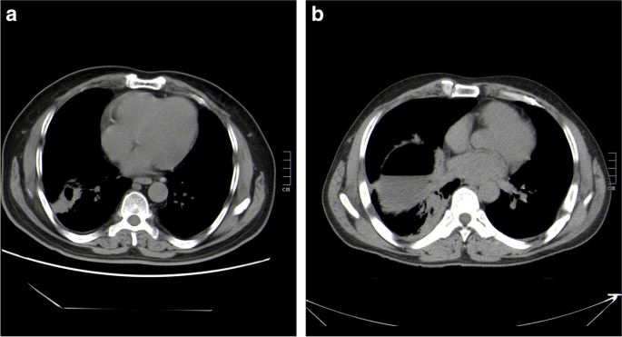 基于CT 的放射组学诺模图用于鉴别肺囊性包虫病与肺脓肿,Parasitology 