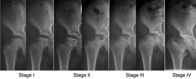 Development of acetabular retroversion in LCPD hips—an observational ...