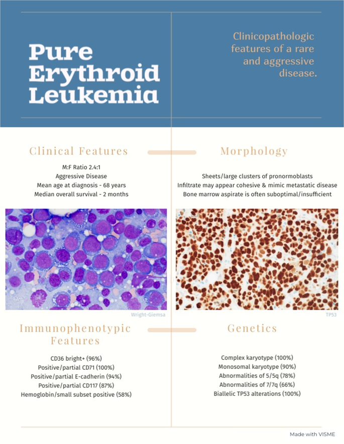 Pure (acute) erythroid leukemia: morphology, immunophenotype ...