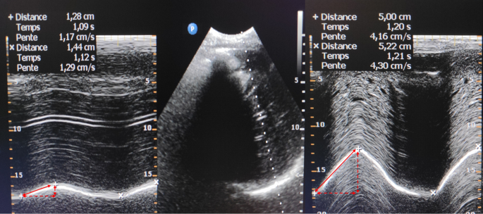 Persistent diaphragm dysfunction after cardiac surgery is