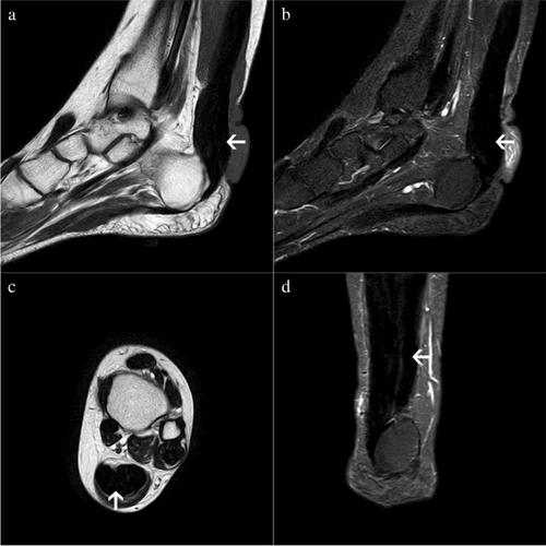 自测问题答案：双脚踝结节逐渐增大,Skeletal Radiology - X-MOL