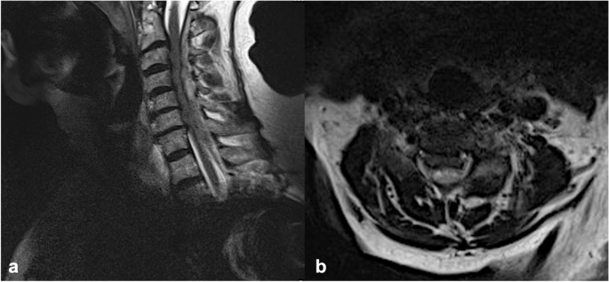 Emergency surgical decompression for spontaneous spinal epidural ...