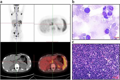 Clinical Profile Etiology And Outcome Of Hemophagocytic Lymphohistiocytosis Associated With