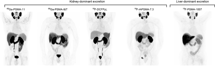 PSMA PET/CT: joint EANM procedure guideline/SNMMI procedure standard ...