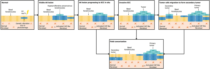 Advances In Photodynamic Therapy For The Treatment Of Actinic Keratosis