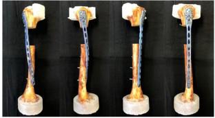 Biomechanical analysis of helical versus straight plating of proximal ...