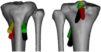 Biomechanical Comparison of Anatomic Versus Lower of Anteromedial and ...