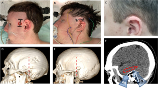 Burr hole microsurgical subtemporal selective amygdalohippocampectomy ...