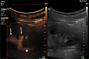 Viability of contrast-enhanced voiding urosonography as an