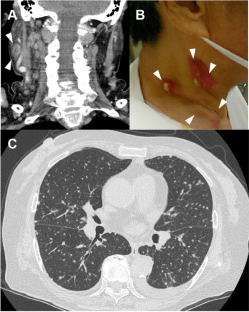 Scrofuloderma and Miliary Tuberculosis in a Patient Taking 