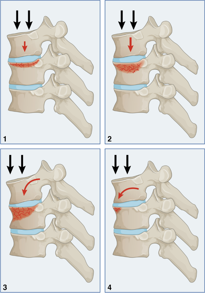 胸椎骨折的分类：四柱理论,International Orthopaedics - X-MOL