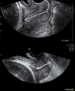 Diagnostic Accuracy Of Pre-induction Cervical Elastography, Volume ...