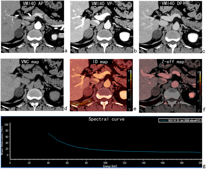 Differential Diagnosis Of Adrenal Adenomas And Metastases Using Spectral Parameters In Dual 5576