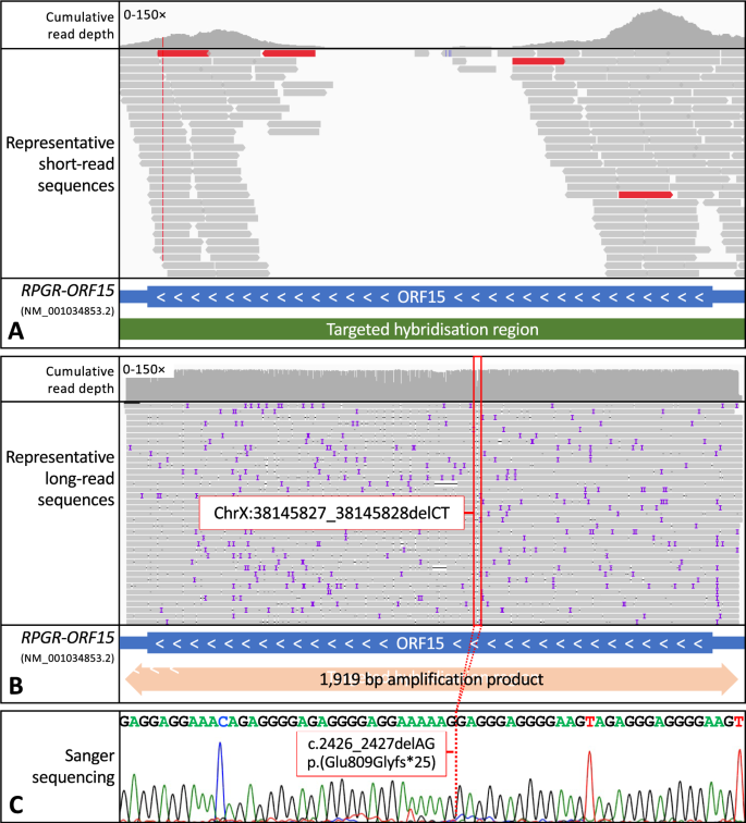 Long-Read Nanopore Sequencing Of RPGR ORF15 Is Enhanced Following DNase ...