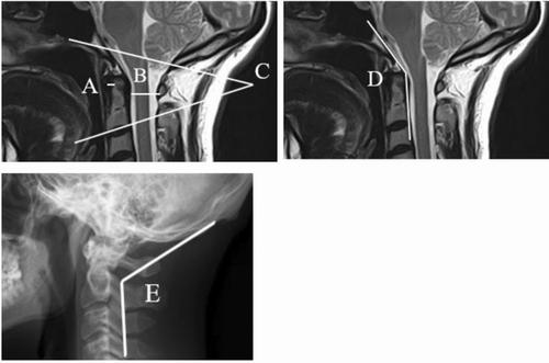 Surgical treatment of craniocervical instability: comparison of two ...