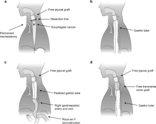 Mckeown Versus Ivor Lewis Esophagectomy For Patients With A History Of Total