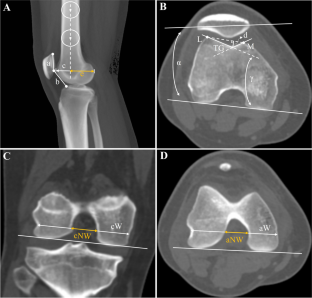 Characterization Of The CT-based Risk Factors For Concomitant ...