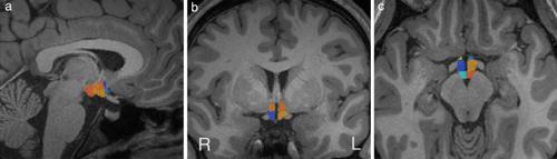 Hypothalamus Volumes In Adolescent Myalgic Encephalomyelitis Chronic Fatigue Syndrome Me Cfs