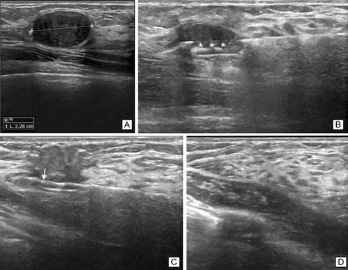 Efficacy And Safety Of Vacuum Assisted Excision Vae Of Fibroadenomas