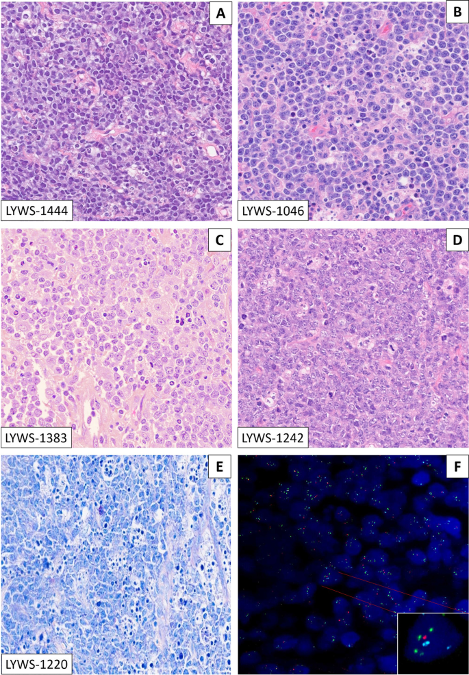 Emerging Entities: High-grade/large B-cell Lymphoma With 11q Aberration ...