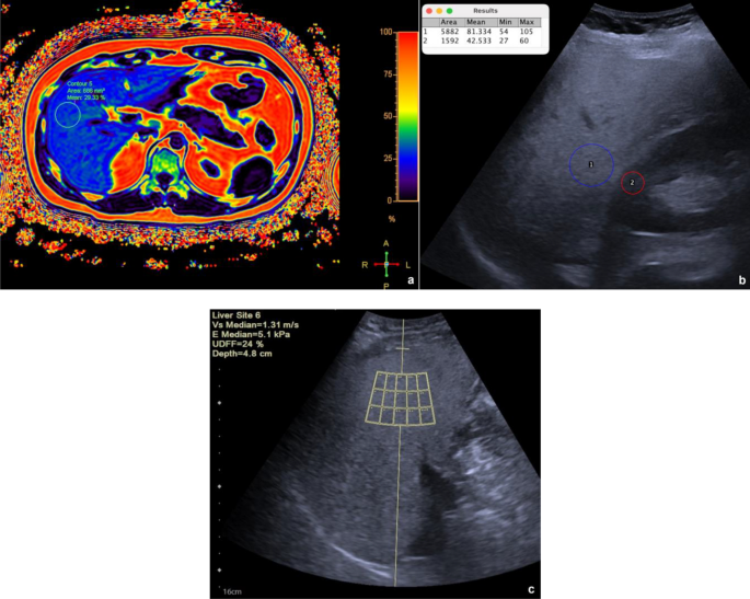 Ultrasound-derived Fat Fraction For Detection Of Hepatic Steatosis And ...