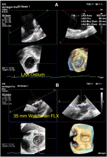 The Emerging Role of Intracardiac Echocardiography (ICE) in Left