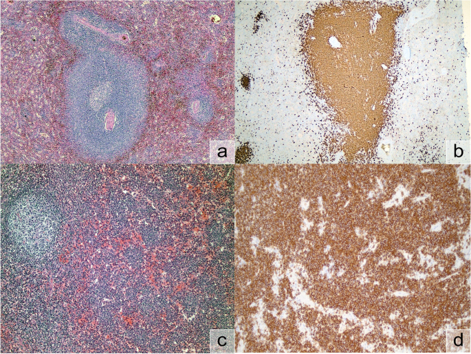 The many faces of nodal and splenic marginal zone lymphomas