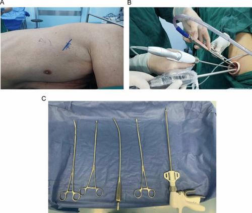 Efficacy And Complications Of Single-port Thoracoscopic Minimally ...