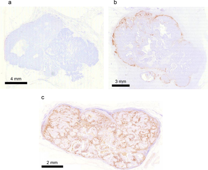 Histological Spatial Analysis On The Induction Of Pd L1 Macrophages By