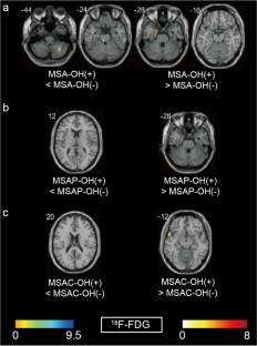 In Vivo Cerebral Metabolic And Dopaminergic Characteristics In Multiple ...