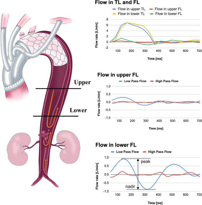 Hemodynamic predictors of negative false lumen remodeling after frozen