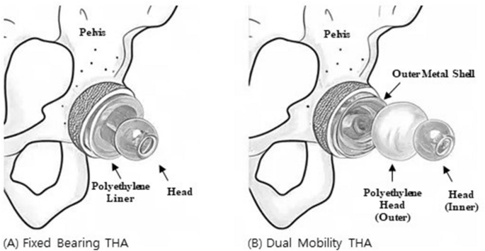 The Use Of Dual Mobility Acetabular Cups In Total Hip Replacement ...